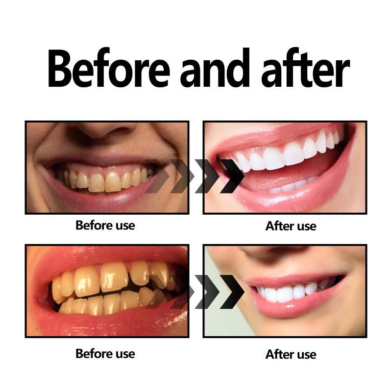 Teeth Whitening Powder Charcoa - Teeth Whitening With Baking Soda recension och pris