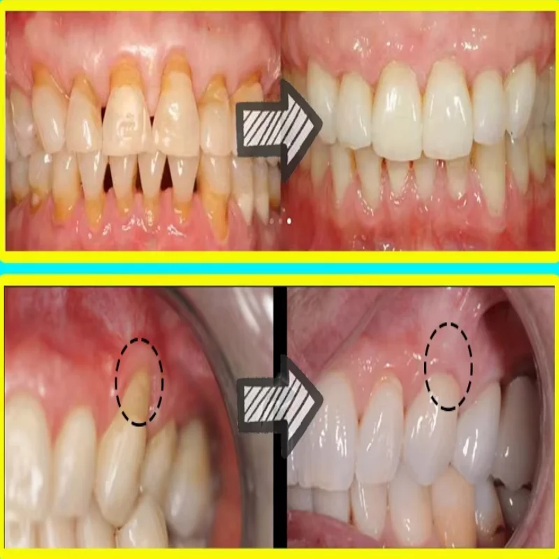 Quickly Repair Gum Serum Relie - Teeth Whitening With Baking Soda recension och pris