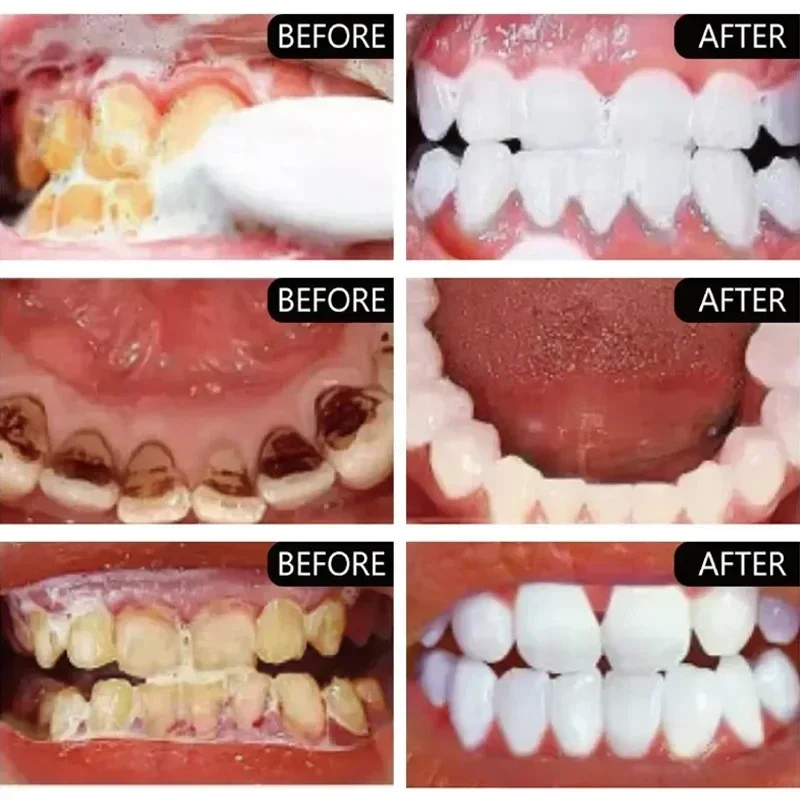 Fast Remove Smoke Stains Tooth - Teeth Whitening Fast recension och pris